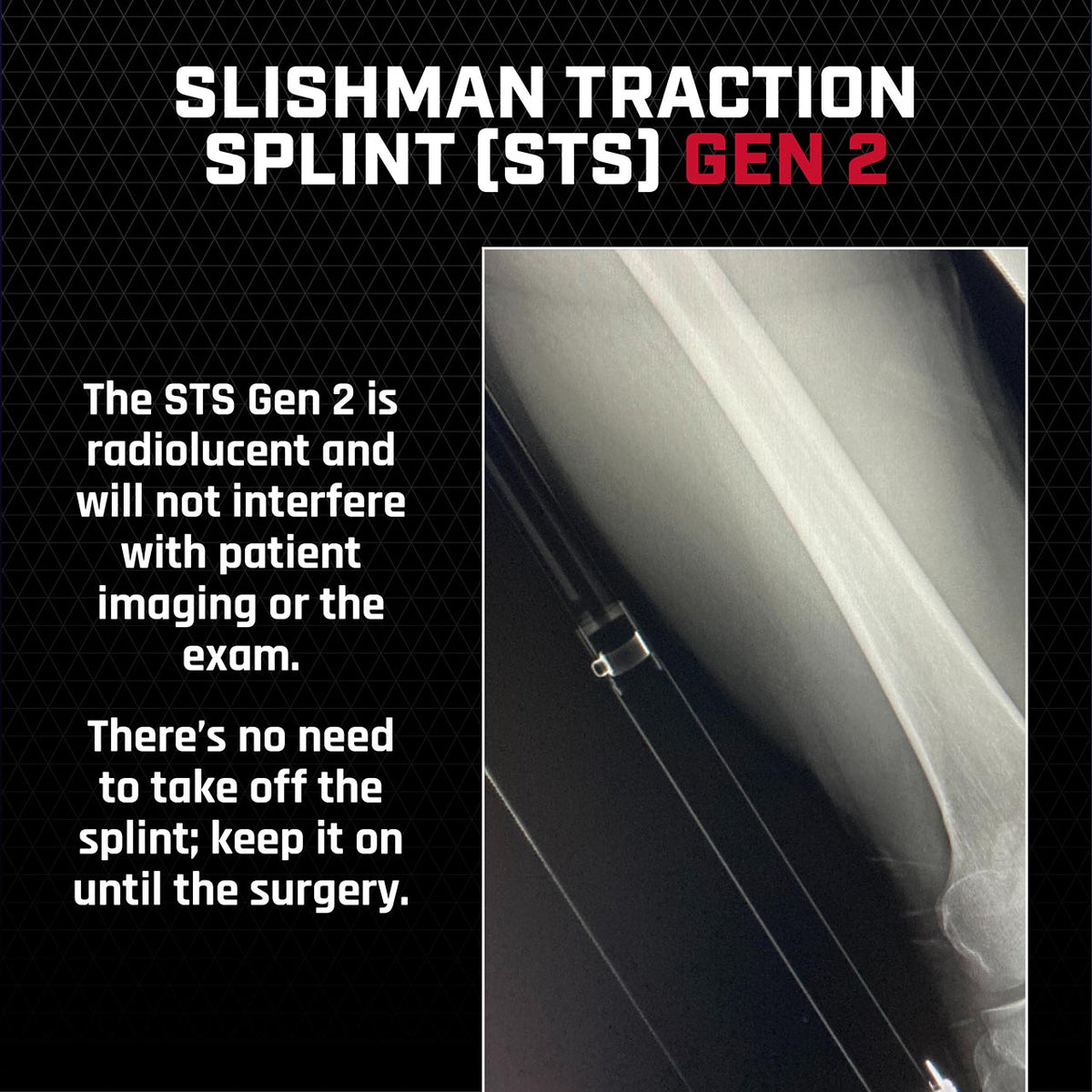 Slishman Traction Splint (STS) - Gen 2