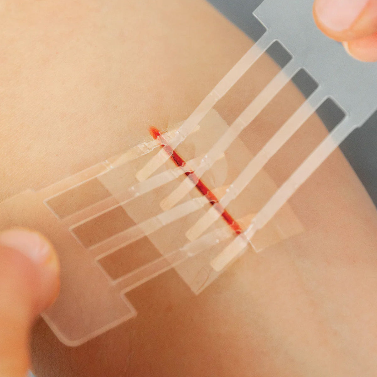 Wound Management