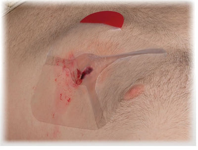 NAR HyFin® Vent Chest Seal, in use