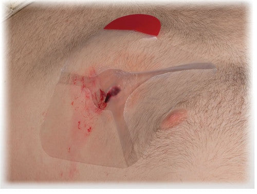 NAR HyFin® Vent Chest Seal, in use