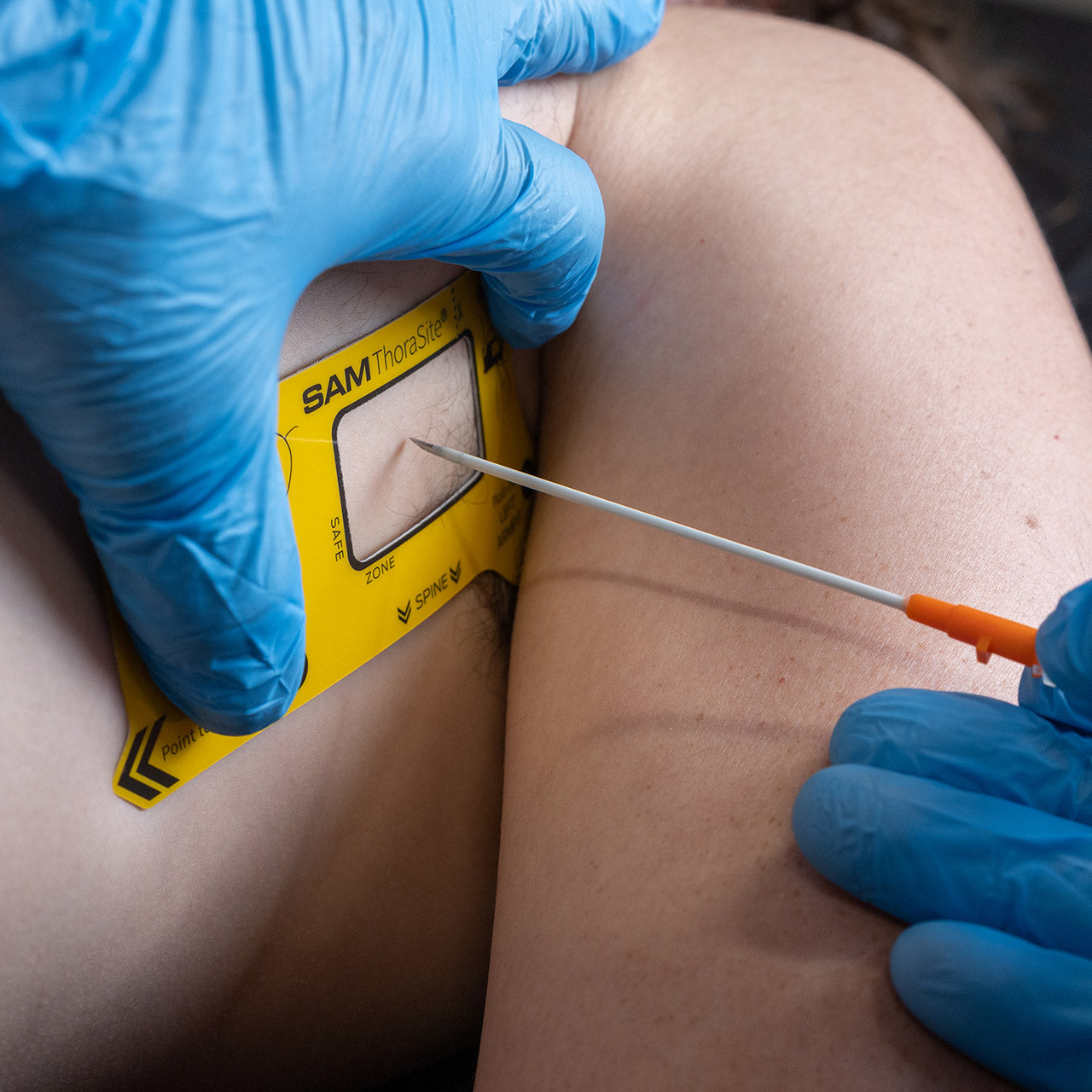 TPAK Needle Decompression Kit