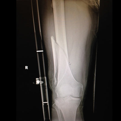 x-ray image of Slishman Traction Splint - STS. The splint is Radiolucent and will not interfere with patient imaging.