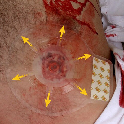 H*VENT Chest Seal, on chest