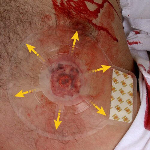 H*VENT Chest Seal, on chest