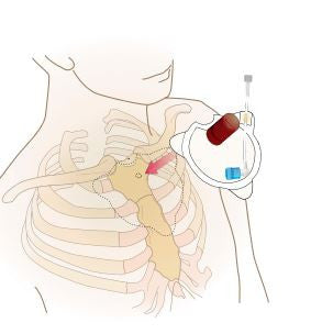 FAST1™ Intraosseous Infusion System, illustration 