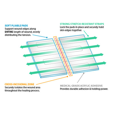 Emergency Laceration Closures, Variety 3 Pack (20/30/40mm or 20/40/50mm)