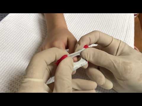 T-Ring Flex Finger Tourniquet